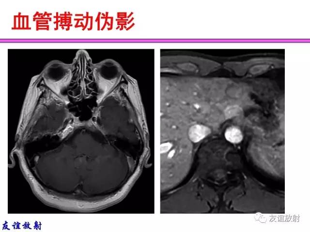 【PPT】MRI伪影与对策
