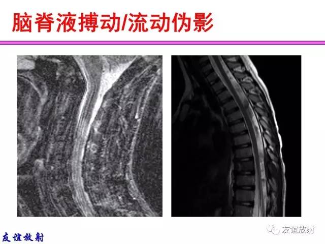 【PPT】MRI伪影与对策