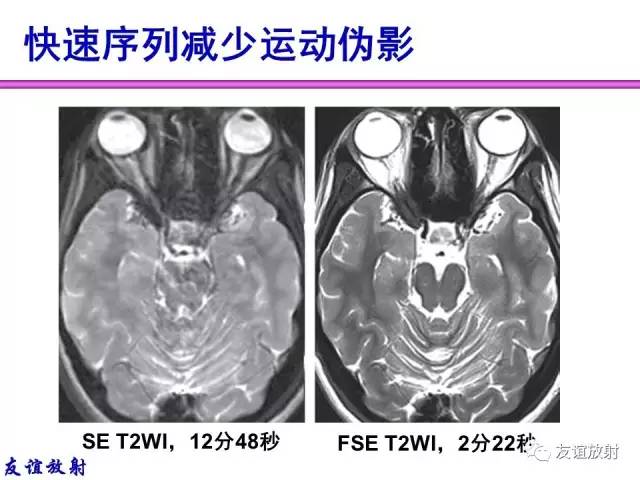 【PPT】MRI伪影与对策
