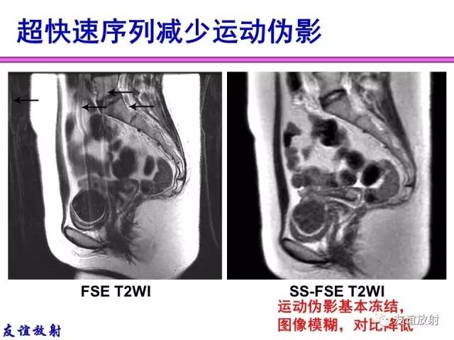 【PPT】MRI伪影与对策