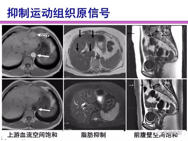 【PPT】MRI伪影与对策