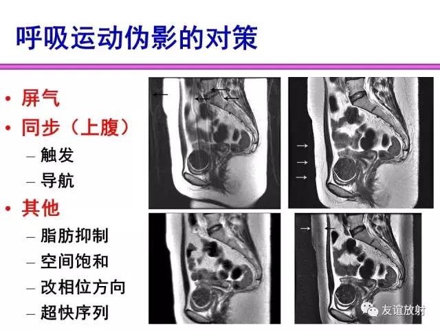【PPT】MRI伪影与对策