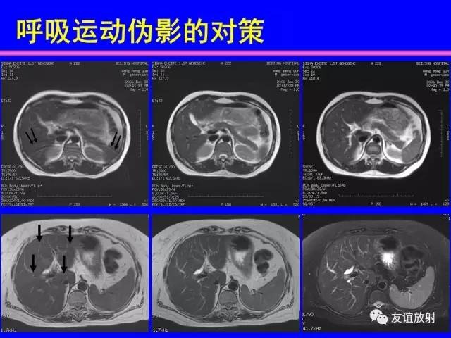 【PPT】MRI伪影与对策