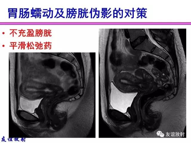 【PPT】MRI伪影与对策