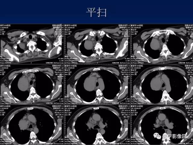 【病例】胸腺瘤1例CT影像表现