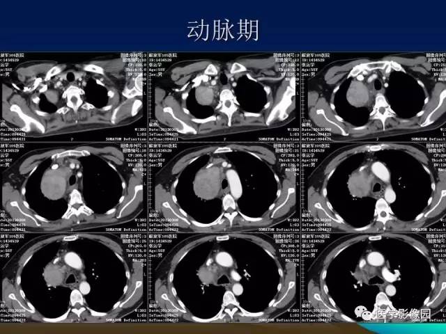 【病例】胸腺瘤1例CT影像表现