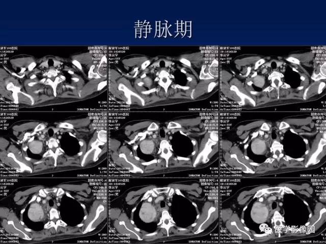 【病例】胸腺瘤1例CT影像表现