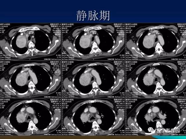 【病例】胸腺瘤1例CT影像表现