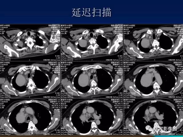 【病例】胸腺瘤1例CT影像表现