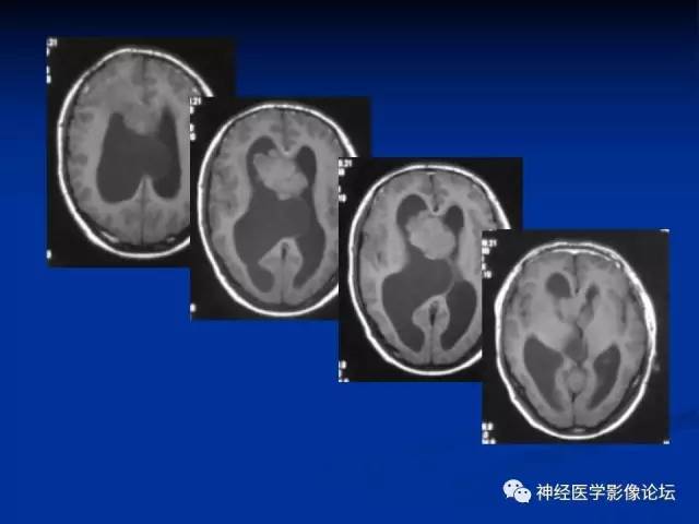 【病例】不伴结节硬化的室管膜下巨细胞星形细胞瘤1例MR