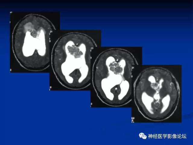 【病例】不伴结节硬化的室管膜下巨细胞星形细胞瘤1例MR