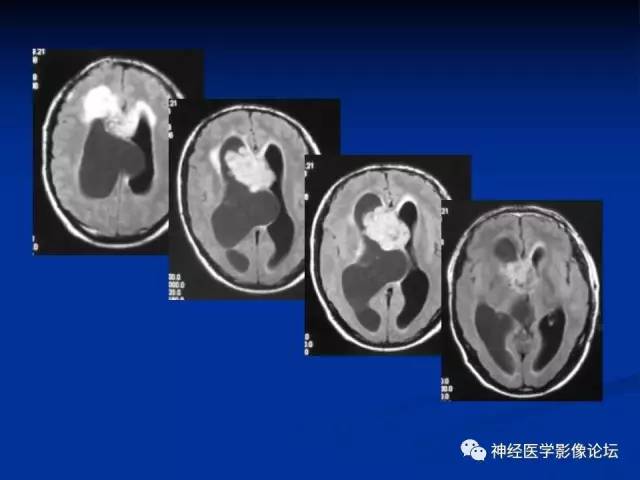【病例】不伴结节硬化的室管膜下巨细胞星形细胞瘤1例MR
