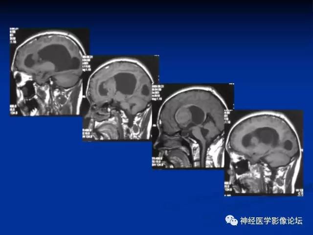 【病例】不伴结节硬化的室管膜下巨细胞星形细胞瘤1例MR