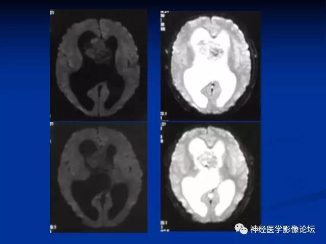 【病例】不伴结节硬化的室管膜下巨细胞星形细胞瘤1例MR