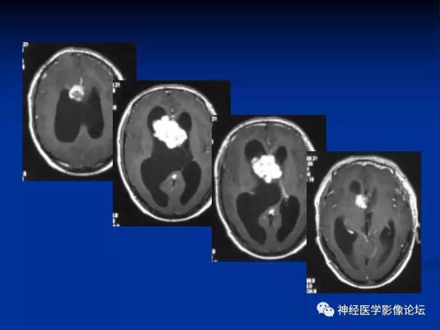 【病例】不伴结节硬化的室管膜下巨细胞星形细胞瘤1例MR