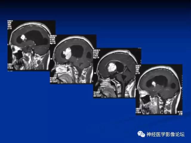 【病例】不伴结节硬化的室管膜下巨细胞星形细胞瘤1例MR