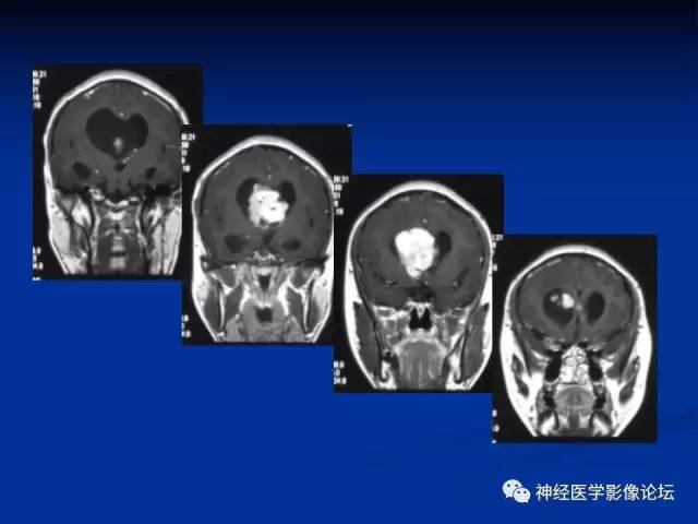 【病例】不伴结节硬化的室管膜下巨细胞星形细胞瘤1例MR