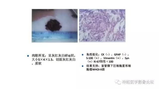 【病例】不伴结节硬化的室管膜下巨细胞星形细胞瘤1例MR