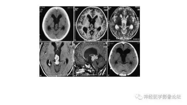 【病例】不伴结节硬化的室管膜下巨细胞星形细胞瘤1例MR