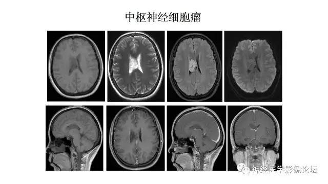 【病例】不伴结节硬化的室管膜下巨细胞星形细胞瘤1例MR