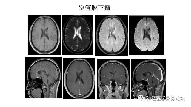【病例】不伴结节硬化的室管膜下巨细胞星形细胞瘤1例MR