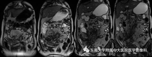 【病例】克罗恩病1例MR