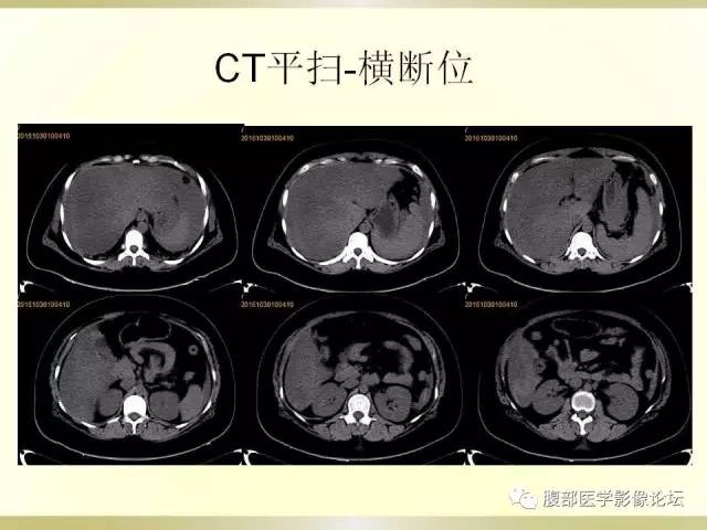 【病例】子宫破裂1例CT影像表现 【病例】子宫破裂1例CT影像表现