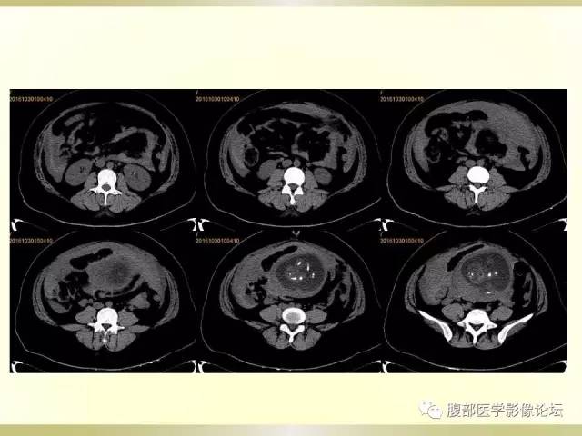 【病例】子宫破裂1例CT影像表现 【病例】子宫破裂1例CT影像表现