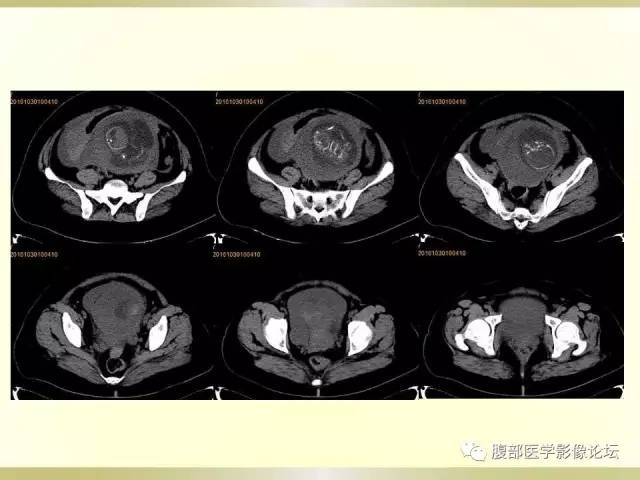 【病例】子宫破裂1例CT影像表现 【病例】子宫破裂1例CT影像表现