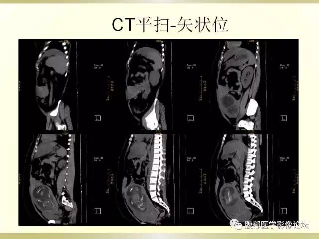 【病例】子宫破裂1例CT影像表现 【病例】子宫破裂1例CT影像表现