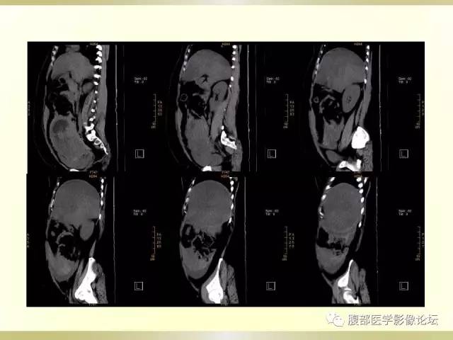 【病例】子宫破裂1例CT影像表现 【病例】子宫破裂1例CT影像表现