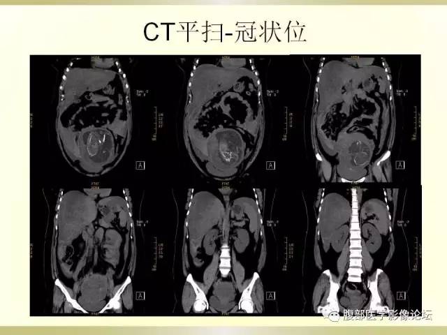 【病例】子宫破裂1例CT影像表现 【病例】子宫破裂1例CT影像表现