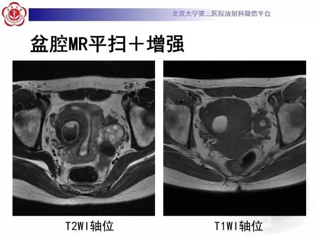 【病例】子宫腺肌症1例MR影像诊断分析