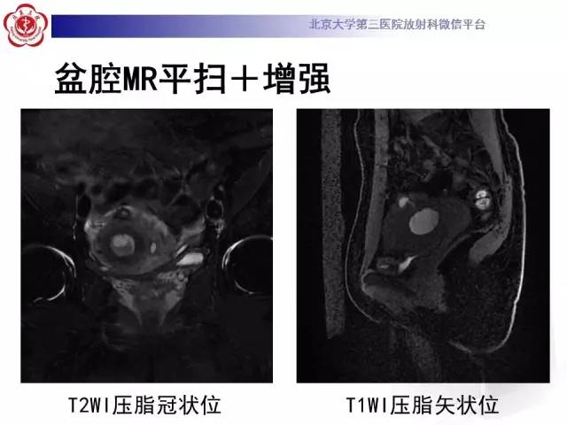 【病例】子宫腺肌症1例MR影像诊断分析