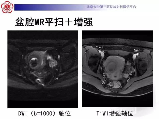 【病例】子宫腺肌症1例MR影像诊断分析