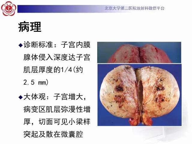 【病例】子宫腺肌症1例MR影像诊断分析