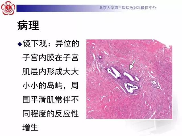 【病例】子宫腺肌症1例MR影像诊断分析