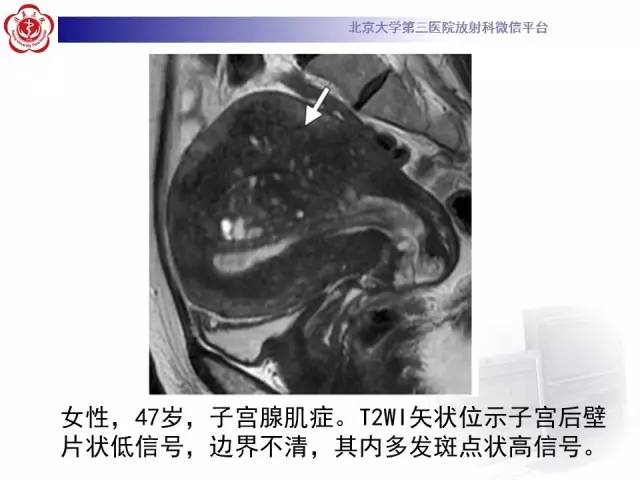 【病例】子宫腺肌症1例MR影像诊断分析