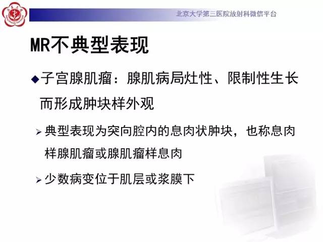 【病例】子宫腺肌症1例MR影像诊断分析