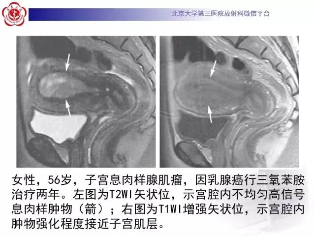【病例】子宫腺肌症1例MR影像诊断分析