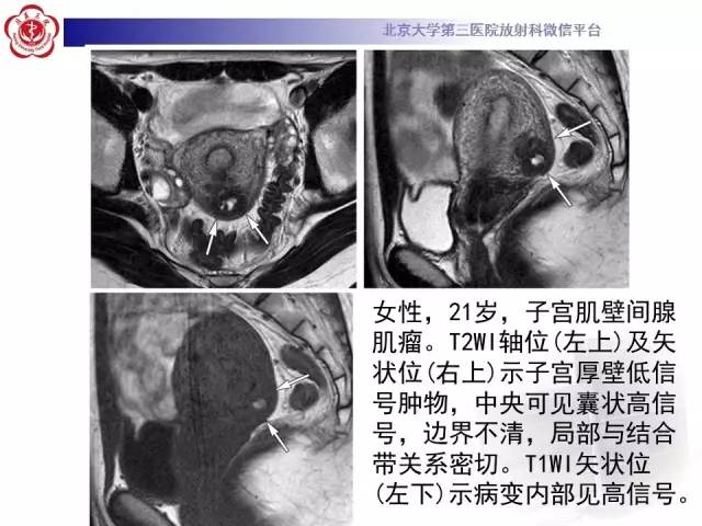 【病例】子宫腺肌症1例MR影像诊断分析