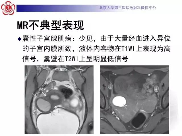 【病例】子宫腺肌症1例MR影像诊断分析