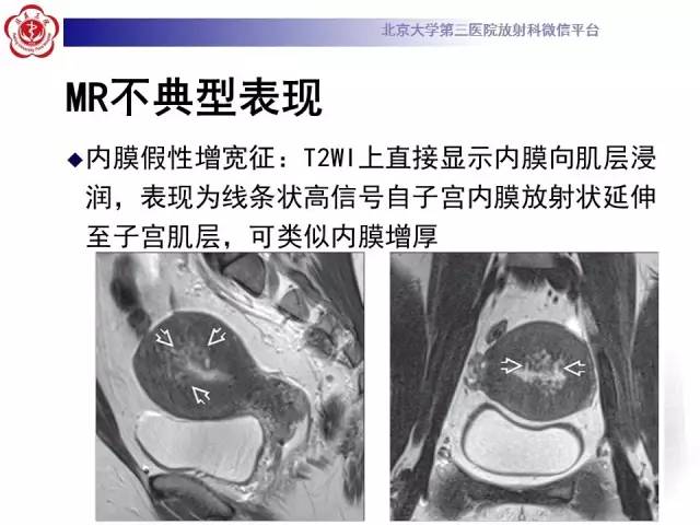 【病例】子宫腺肌症1例MR影像诊断分析