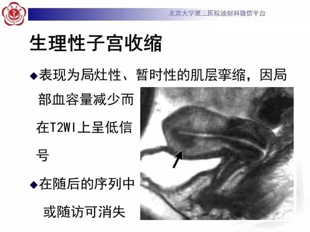 【病例】子宫腺肌症1例MR影像诊断分析