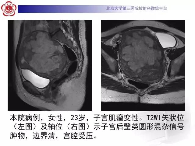 【病例】子宫腺肌症1例MR影像诊断分析