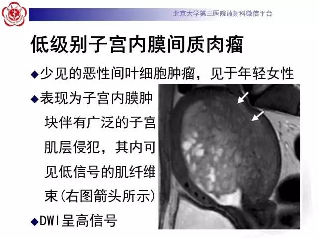 【病例】子宫腺肌症1例MR影像诊断分析
