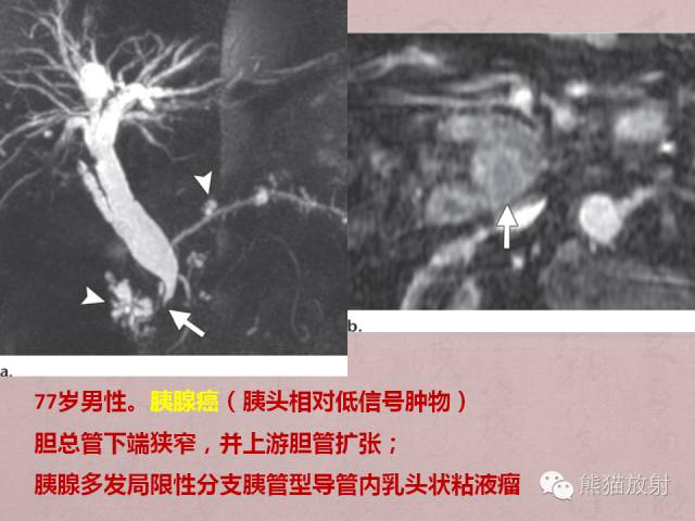 胰腺非上皮及上皮肿瘤鉴别之影像病理相关表现