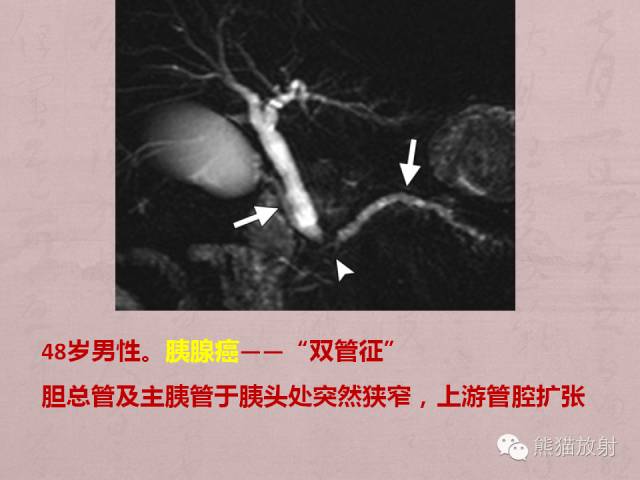 胰腺非上皮及上皮肿瘤鉴别之影像病理相关表现