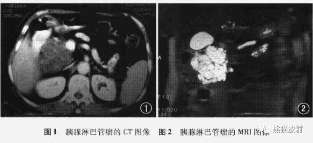 胰腺非上皮及上皮肿瘤鉴别之影像病理相关表现