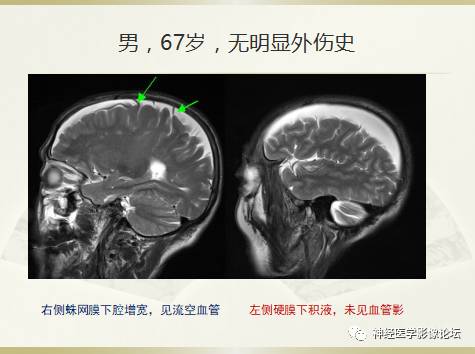 硬膜下积液与蛛网膜下腔间隙增宽鉴别 硬膜下积液与蛛网膜下腔间隙增宽鉴别